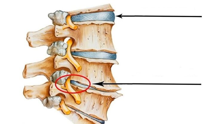 lesión medular en caso de osteocondrose cervical