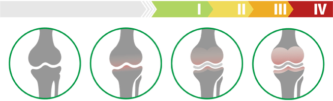 Fases clínicas de artrose da articulación do xeonllo (grao de artrose da articulación do xeonllo)