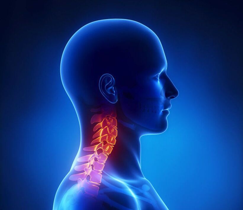 A osteocondrose cervical é unha patoloxía da columna vertebral, que pode desfacerse na casa
