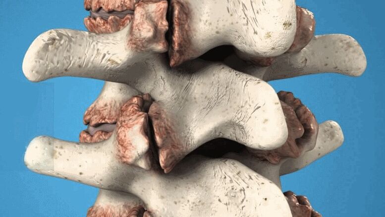 osteofitos da columna vertebral como causa da dor lumbar