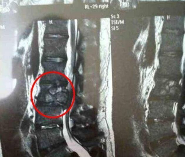 tumor da columna vertebral como causa de dor nas costas