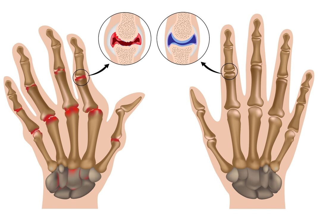 Articulacións da man saudables e afectadas pola poliartrite