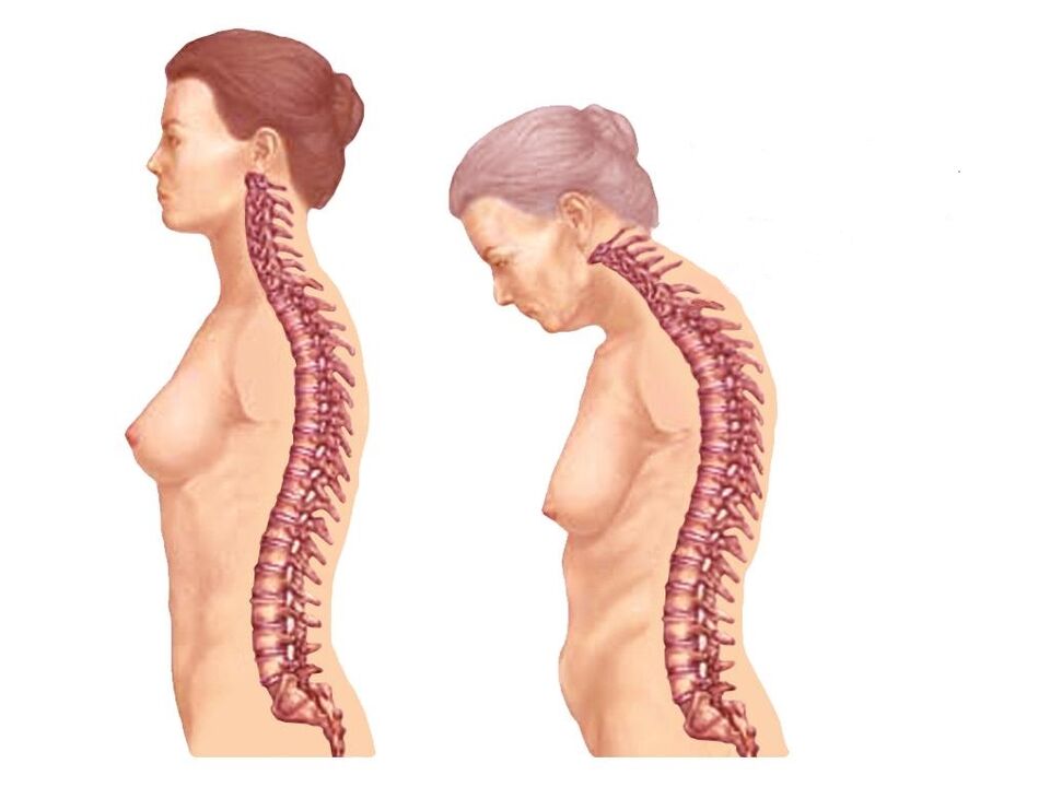 columna vertebral curva sa con osteocondrose