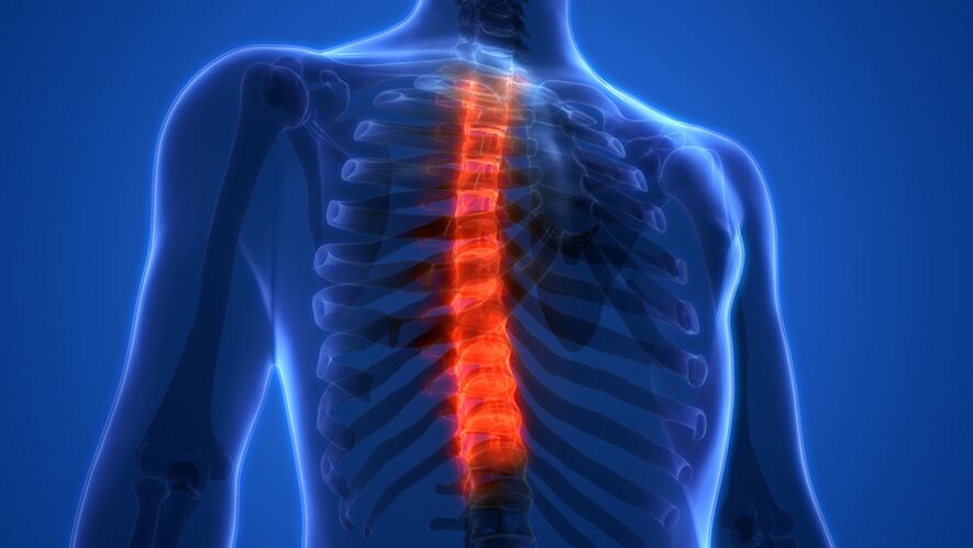 Osteocondrose da columna vertebral torácica, caracterizada pola destrución dos discos intervertebrais