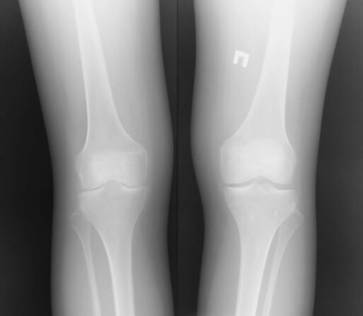 A radiografía da articulación do xeonllo