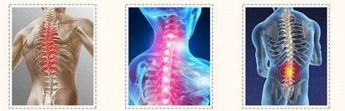 Lesións espinais de osteocondrose