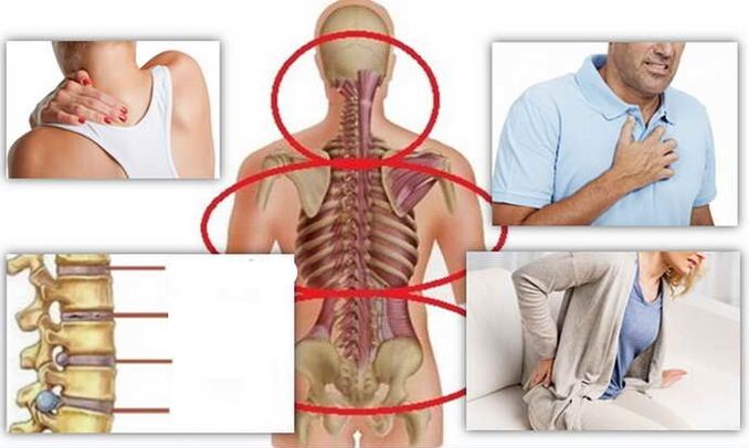 Lugares de enfermidade para osteocondrose