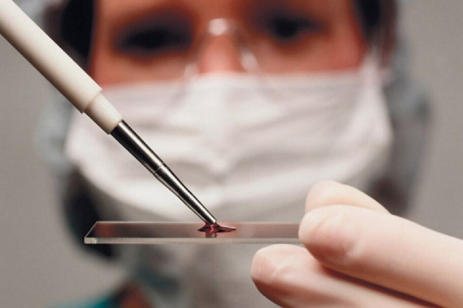 A artrite é unha enfermidade inflamatoria, e a súa presenza revélase mediante análises de sangue.