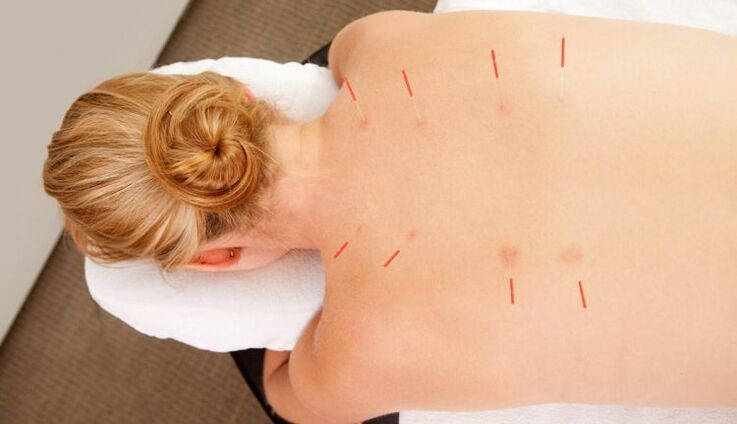A acupuntura para a osteocondrose torácica, que ten moitas vantaxes